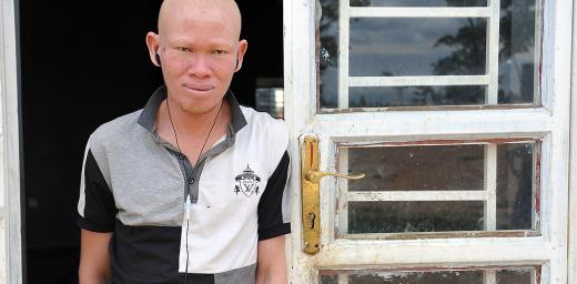 Patrick Tambure fled the Democratic Republic of the Congo with his family, because they no longer felt safe. He and four of his eight siblings have albinism. Photo: LWF/M. Renaux (2015)